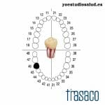 FRASACO DIENTE AG-3 ZPUK #46 ENDODONCIA